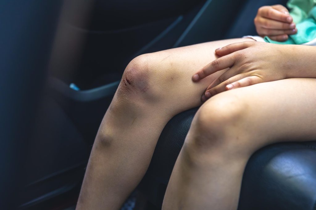 A close-up of a child sitting in the backseat of a car with a scraped and slightly bruised knee, with a hand resting on their leg.