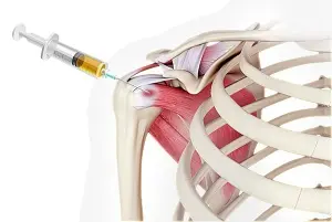 Shoulder Injection Procedure Concord NC
