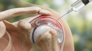 subacromial injection therapy